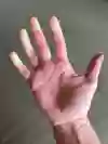 Hand där flera av fingrarna har bleka områden. 