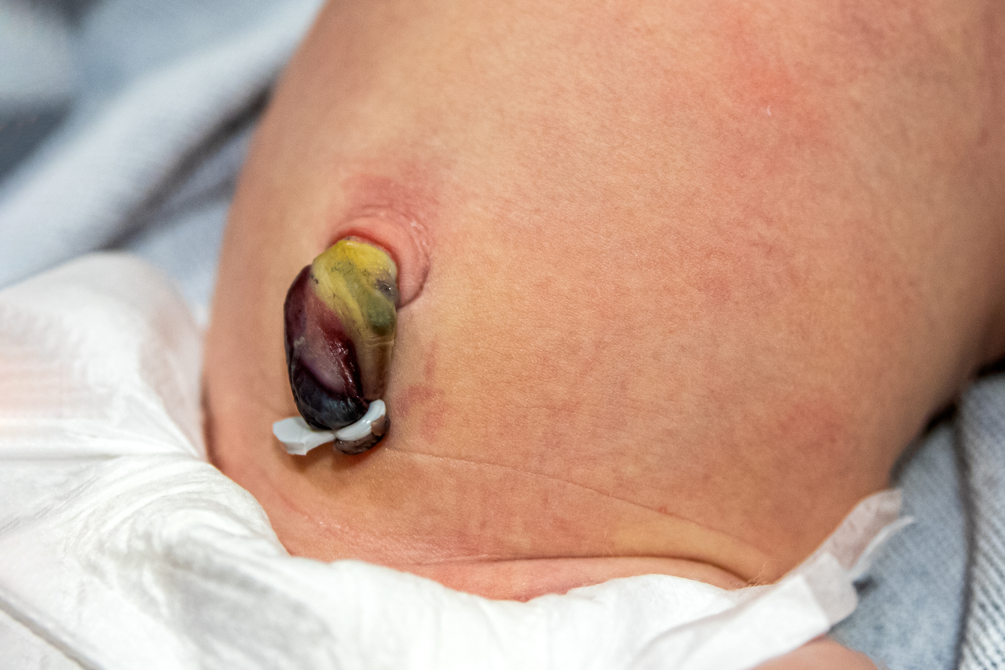Ett nyfött barns navel.