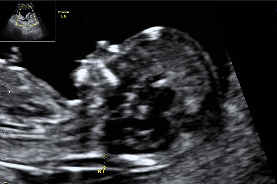Ultraljudsbild av ett foster i magen med markering för nackspalten som mäts