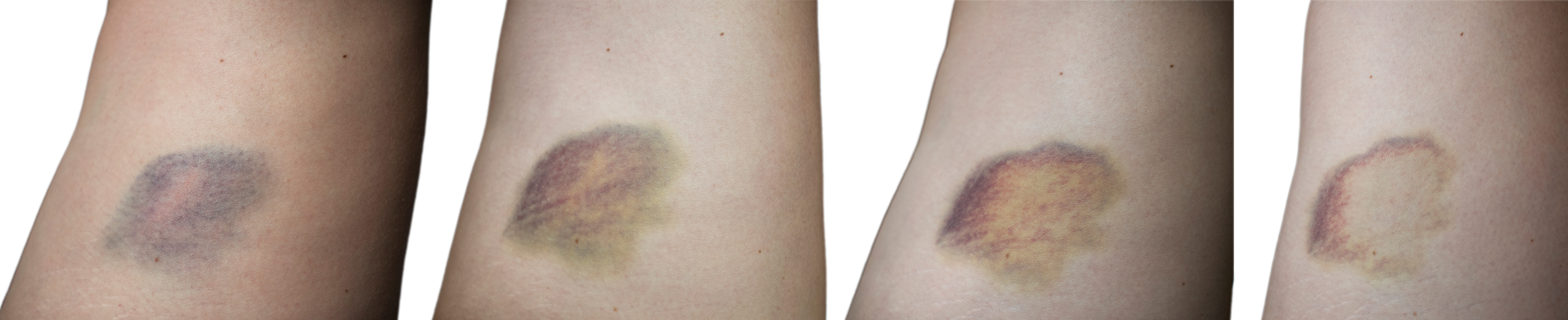 Bildserie som visar hur blåmärken kan skifta i färg med tiden. 