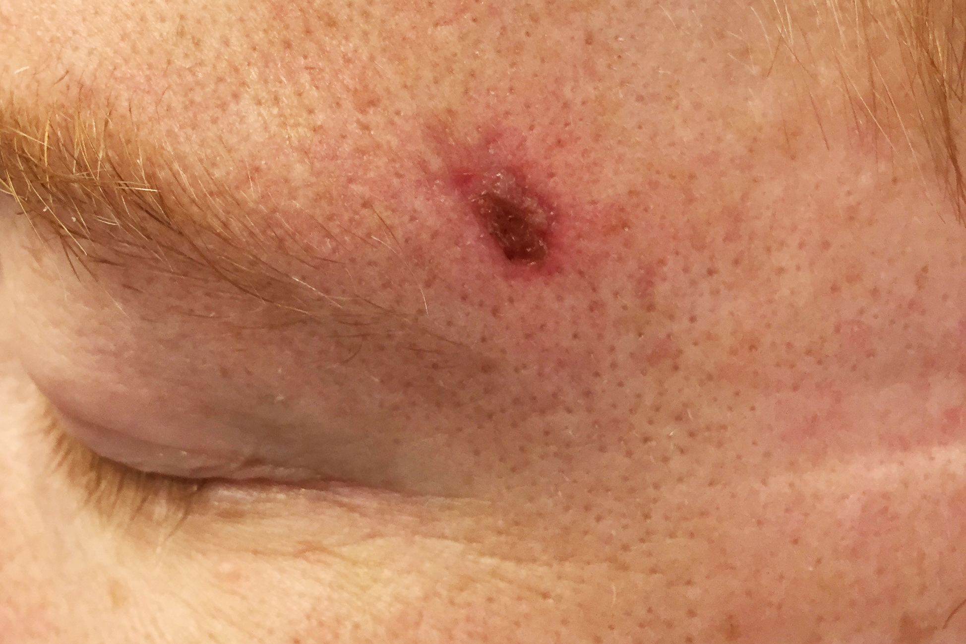 Närbild på hud med basalcellscancer, som liknar ett sår. Fotografi