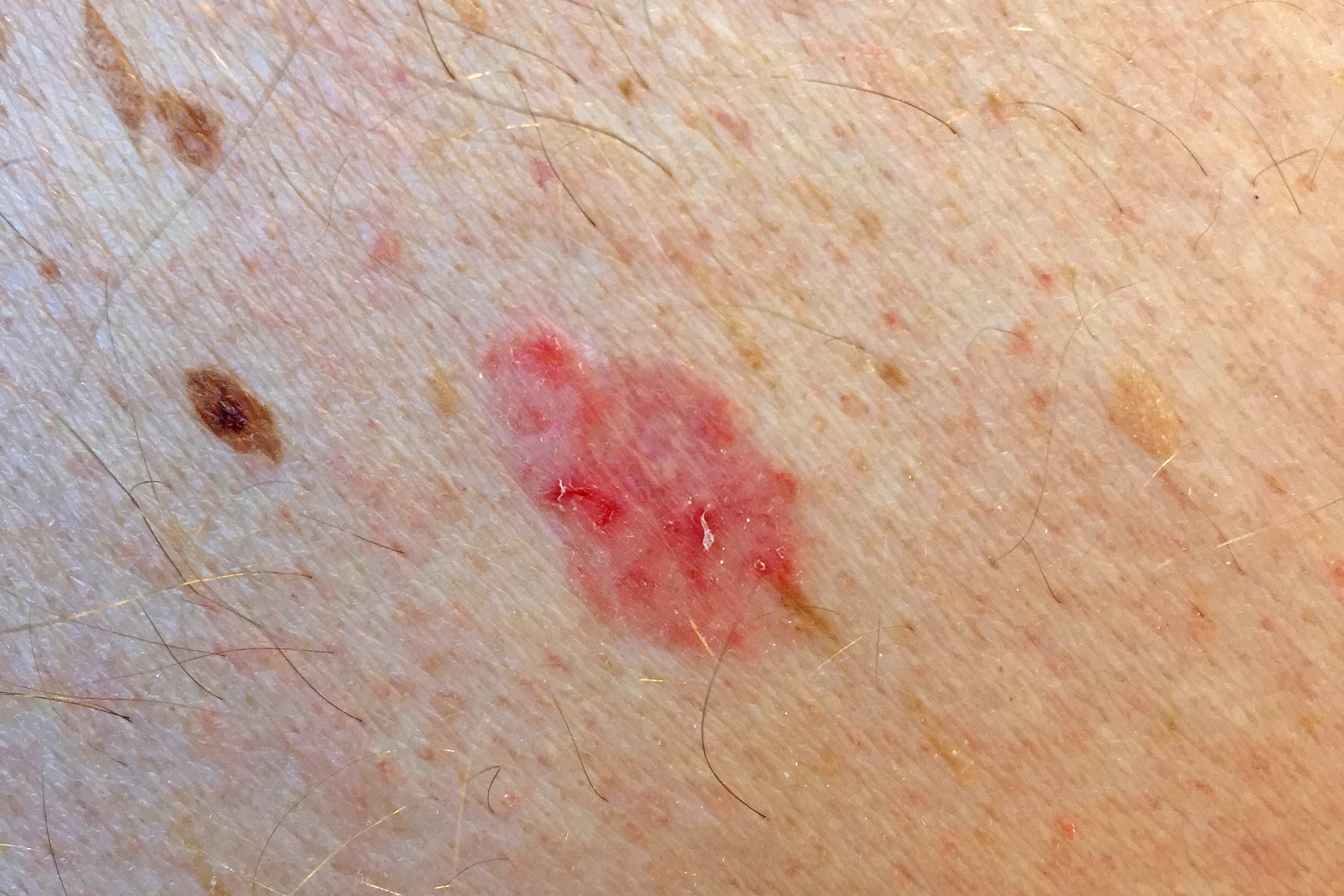Närbild av hud med en röd fläck. Fotografi.