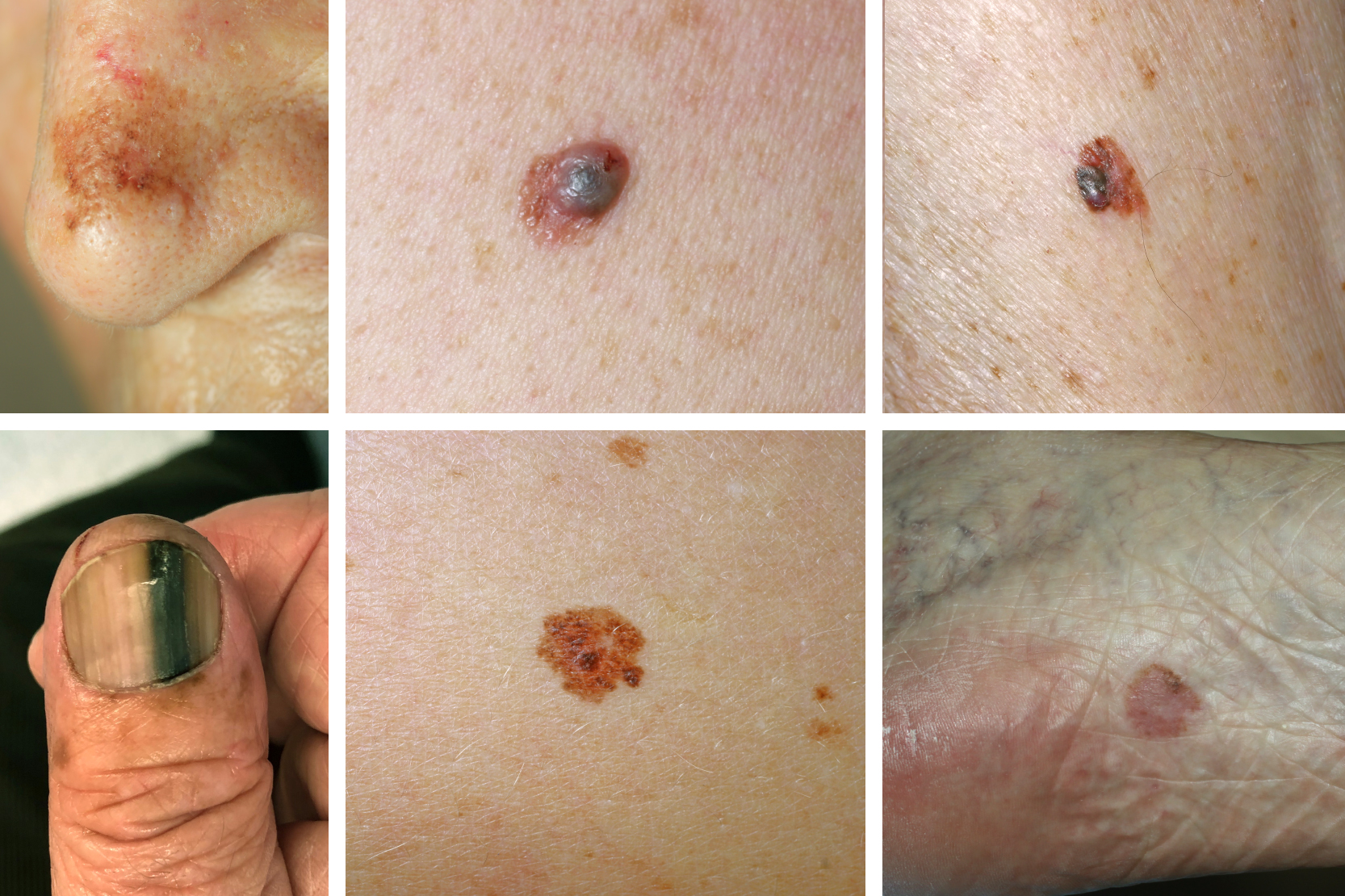 melanotan biverkningar Malignt melanom – hudcancer