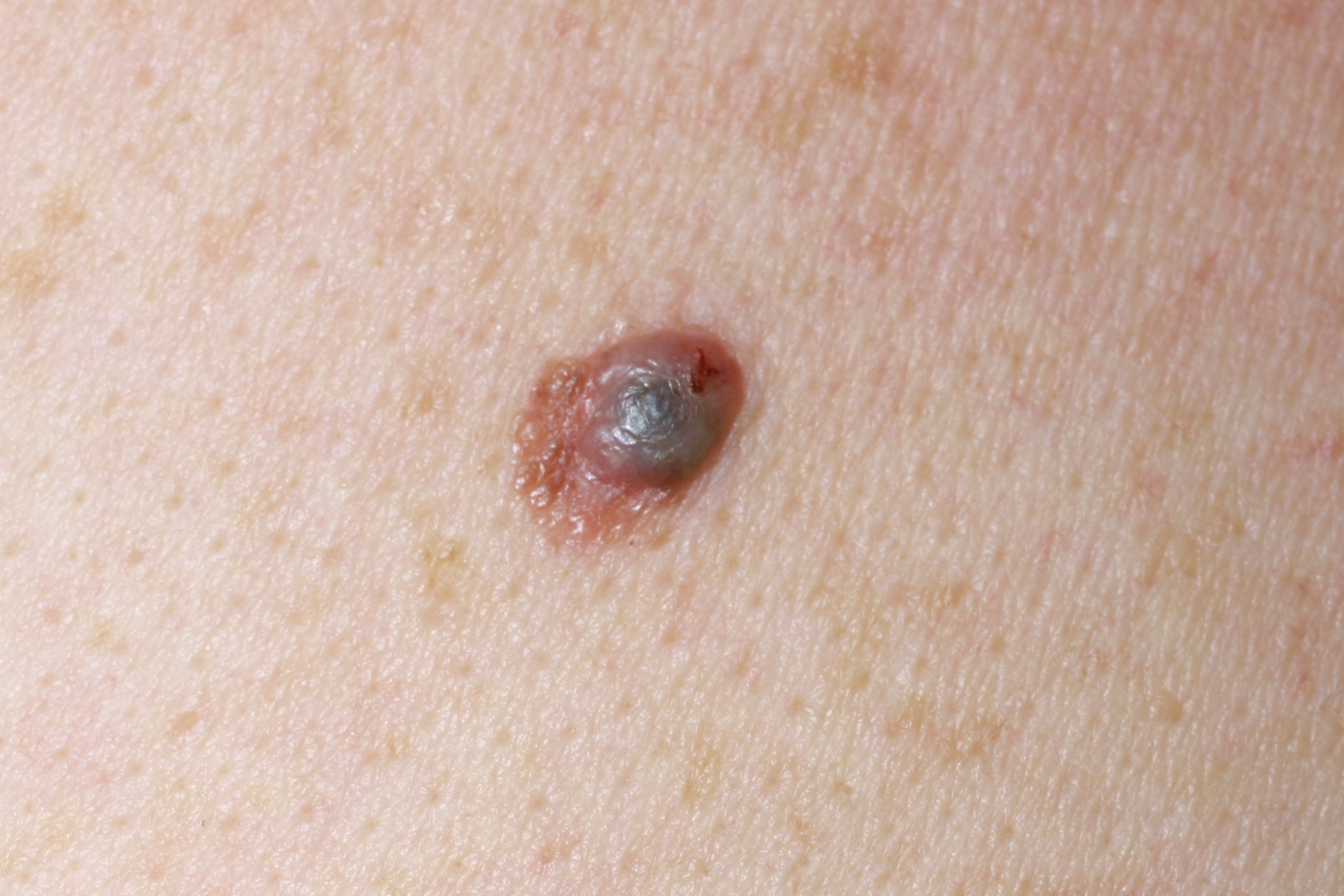 Knutformad melanom på huden. Fotografi.