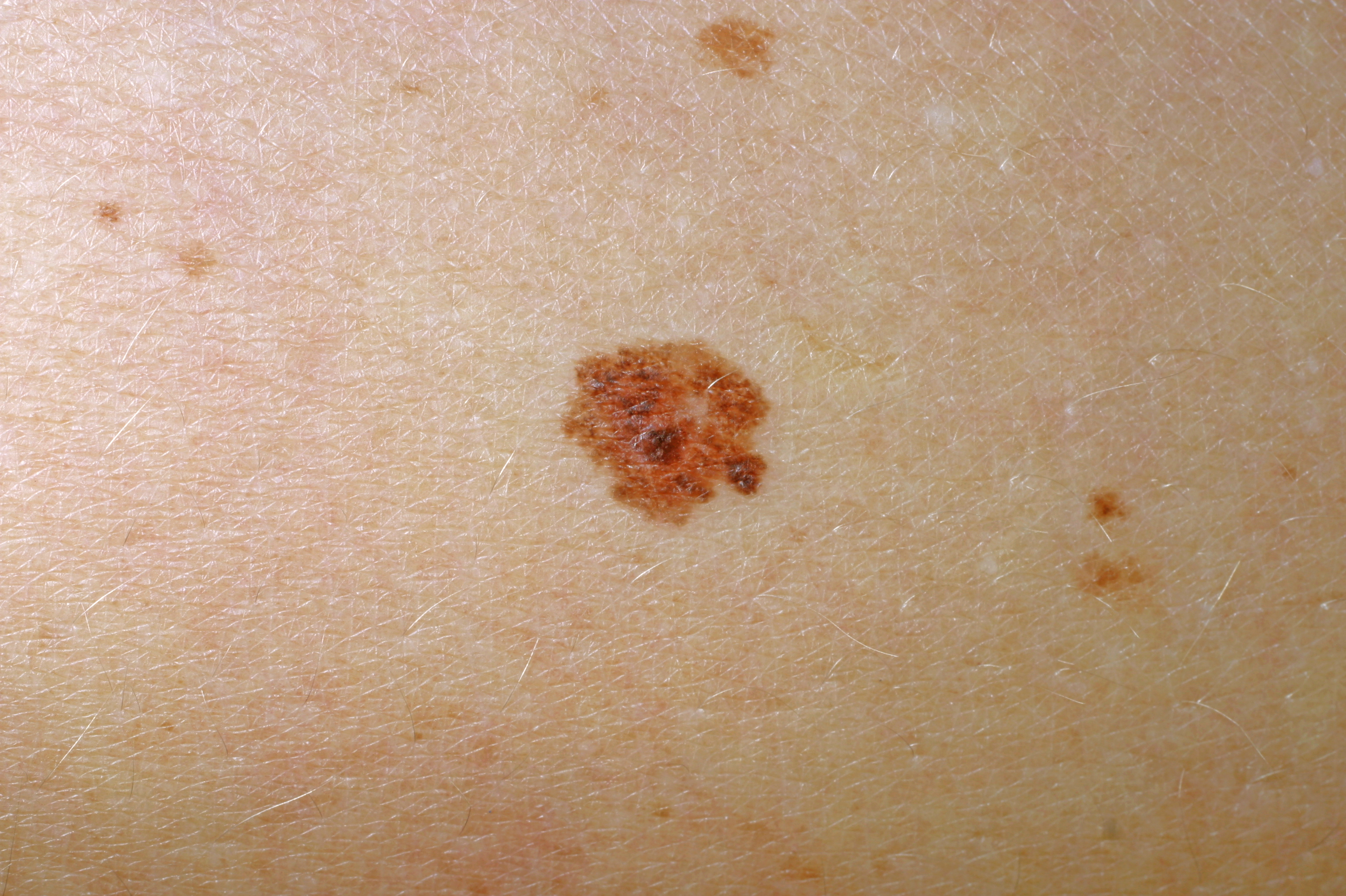 Ytligt växande maligna melanom på hud. Fotografi.