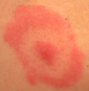 البقعة الحمراء التي تشبه دائرة قد تكون مرض لايم.