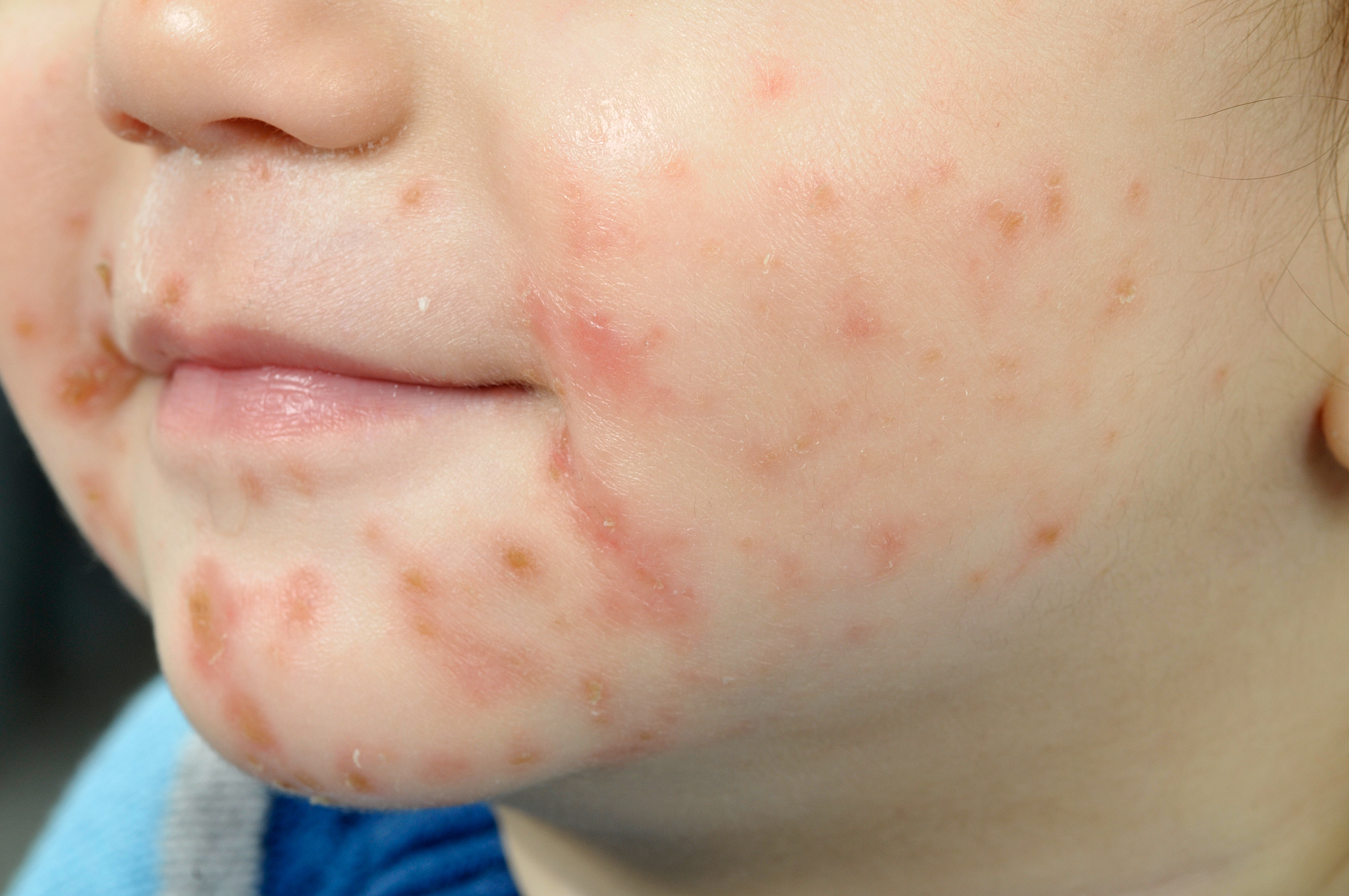 allergisk reaktion hud behandling