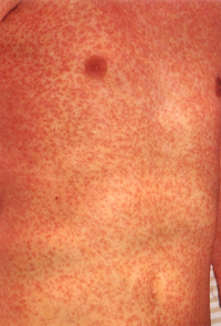 Överkropp med många röda prickar som sitter tätt.