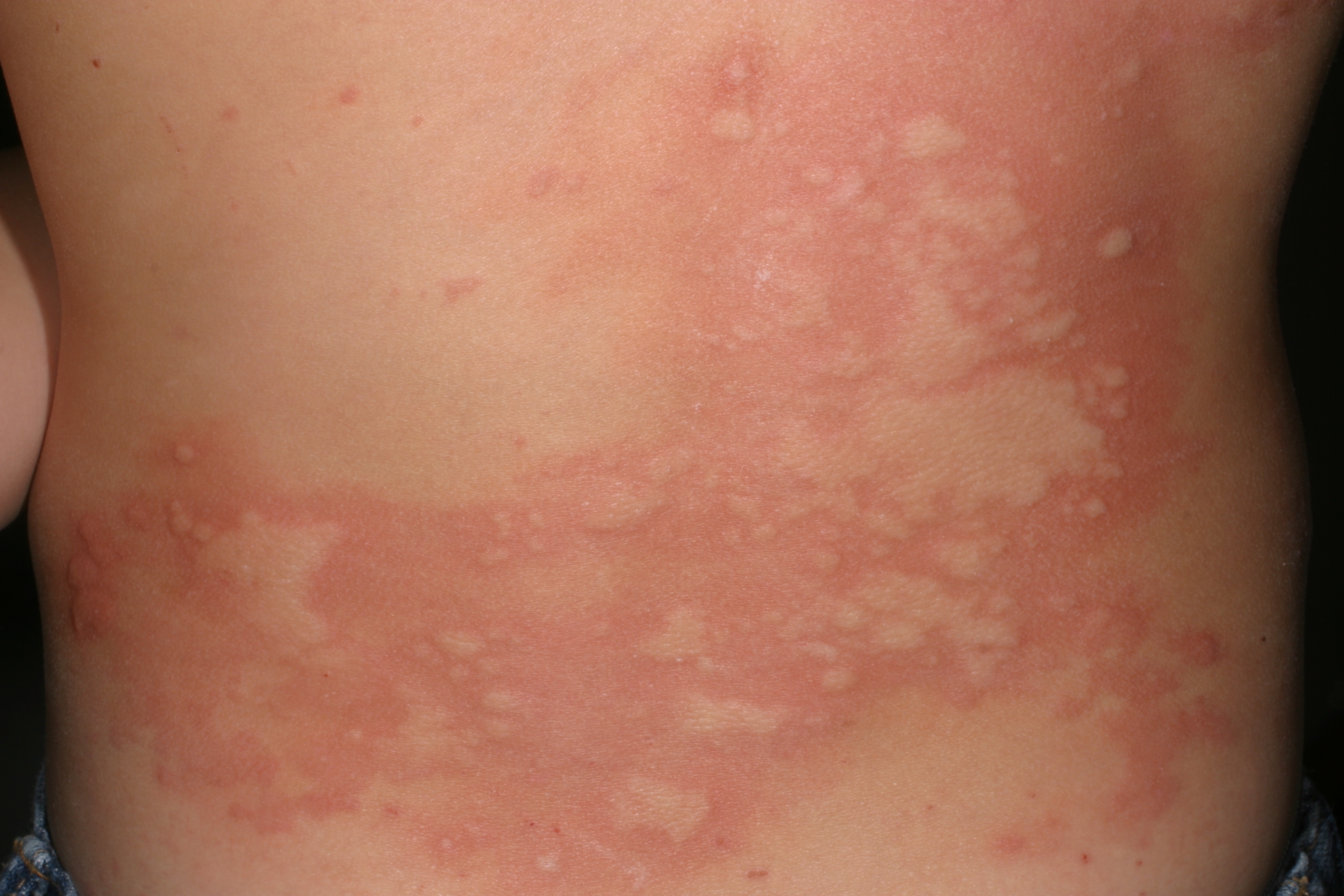 Nässelutslag på ljus hud, på stort sammanhängande område på rygg.