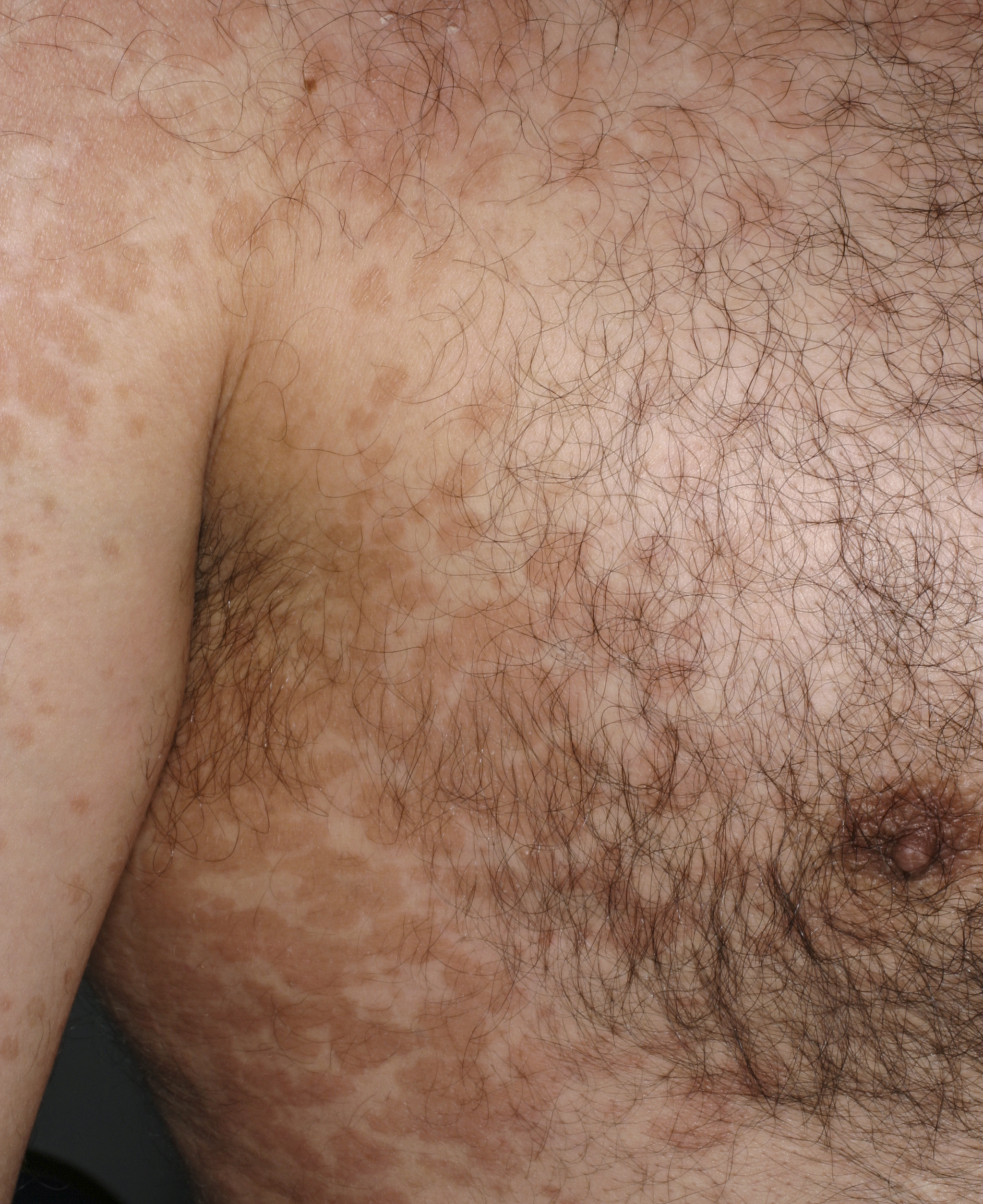 I huden behandling svamp Svampinfektioner