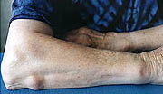 Illustration av reumatiska knutor på arm.