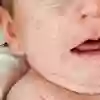 Prickar i ansiktet på en bebis. Fotografi. 