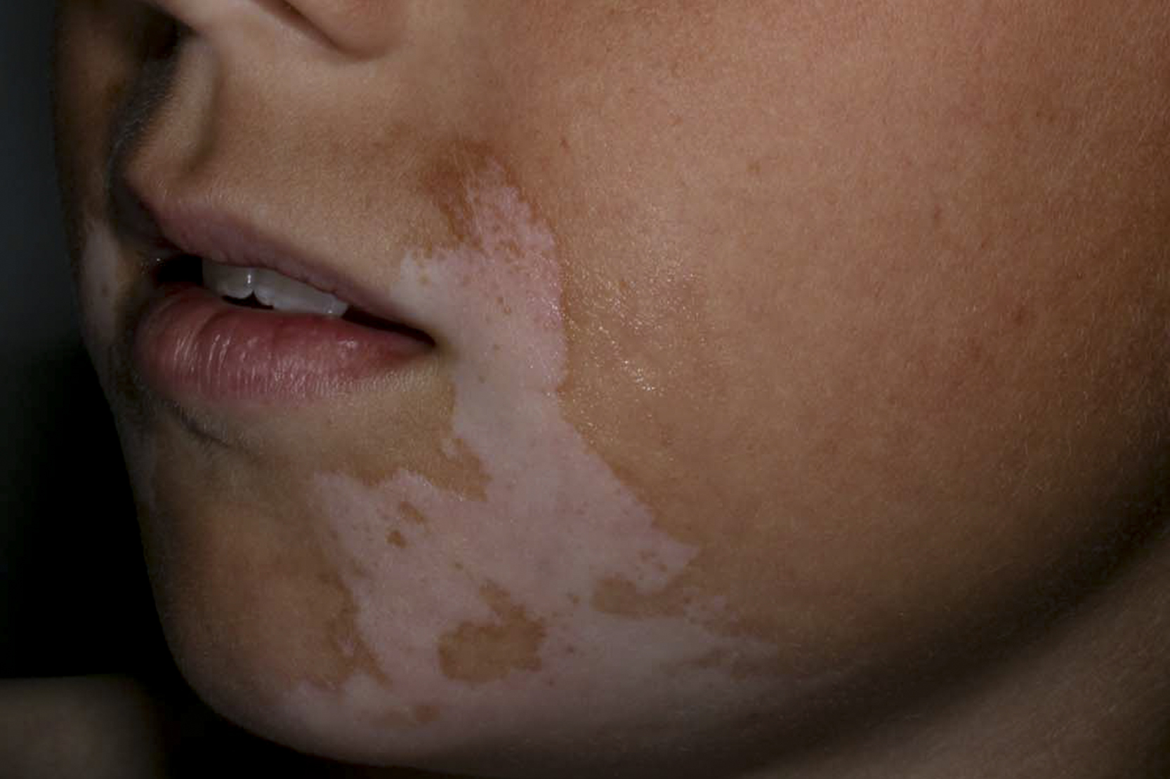 Vitiligo i ansiktet på ett barn