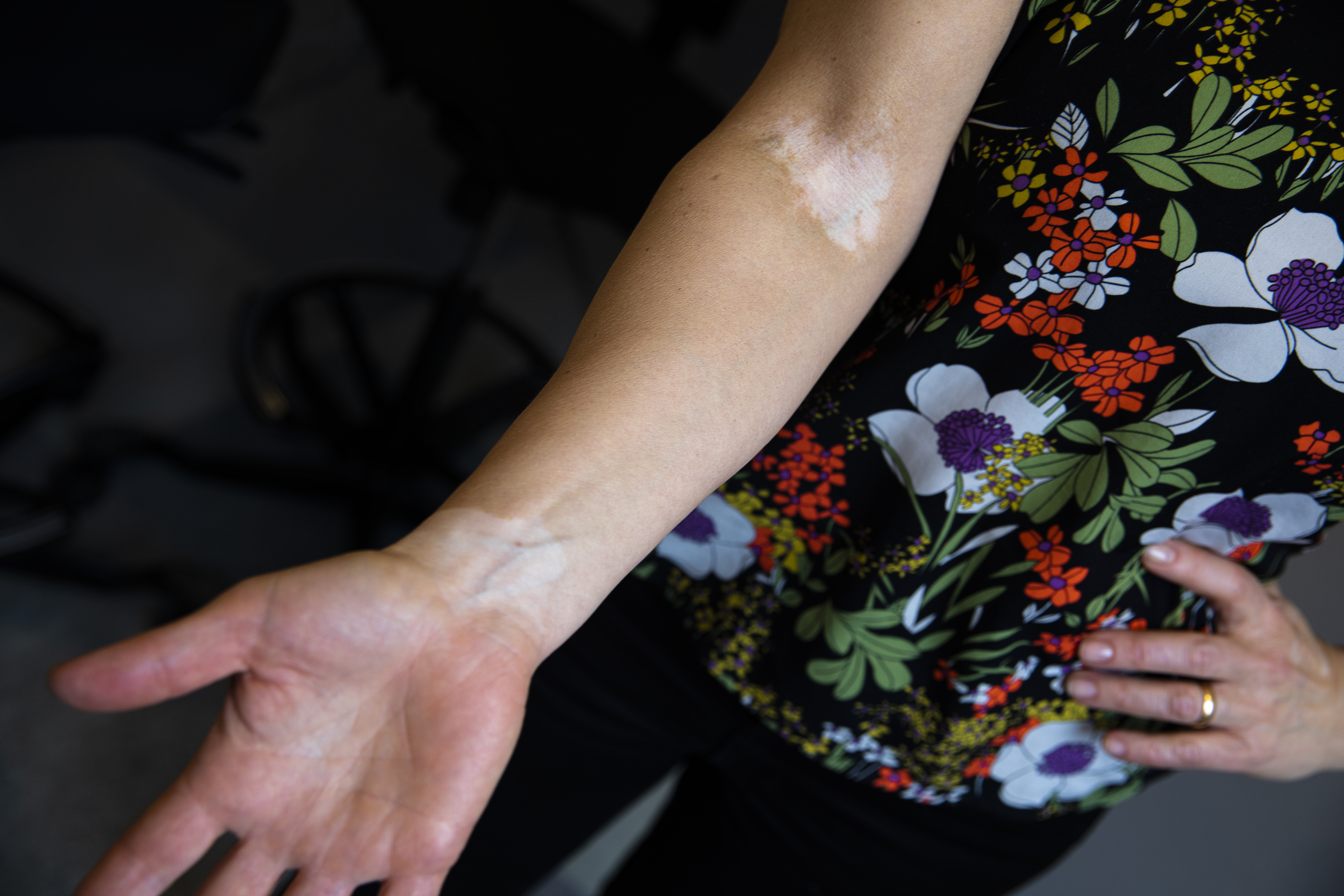 Vitiligo på underarm