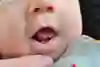 Barn som har en svampinfektion i munnen.
