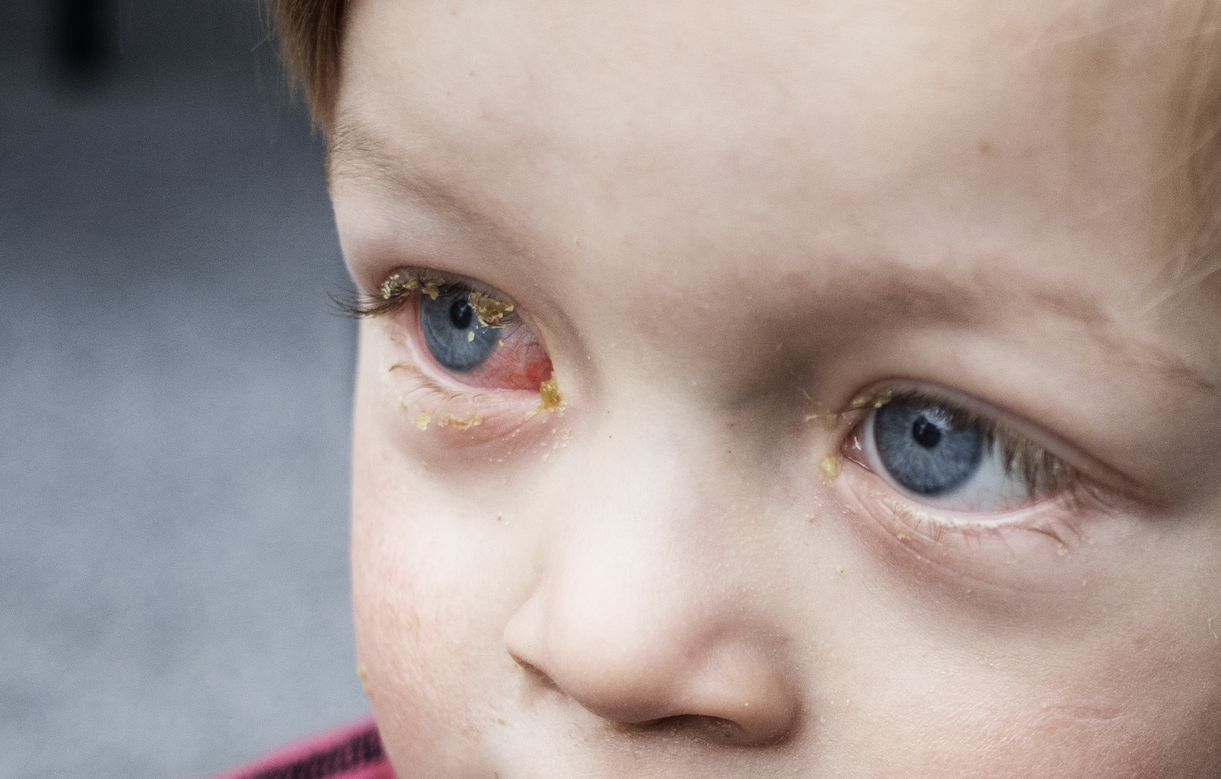 Ett barn med ögoninflammation i båda ögonen
