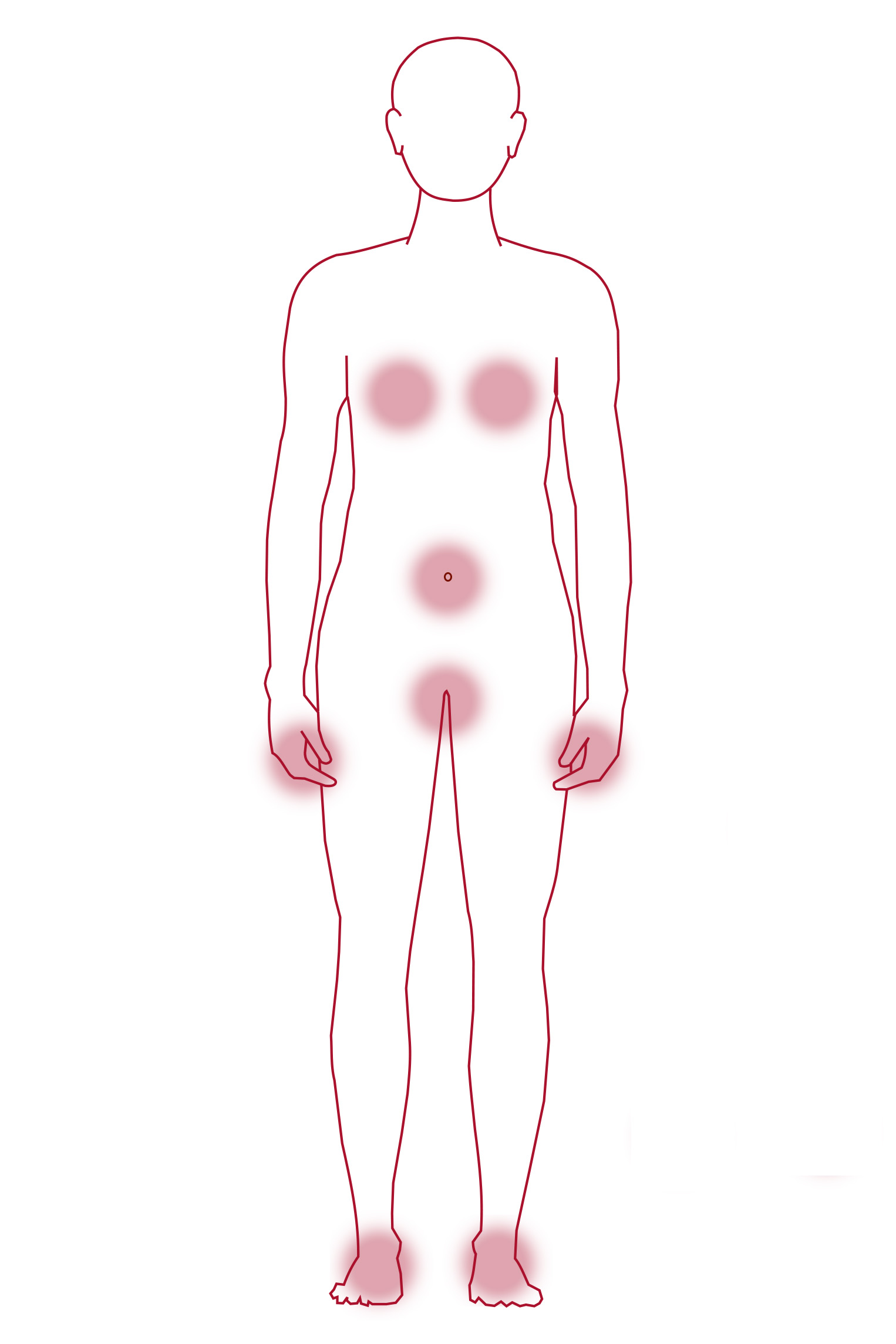 Kroppskontur där de områden där skabb kliar är markerade. Illustration. 