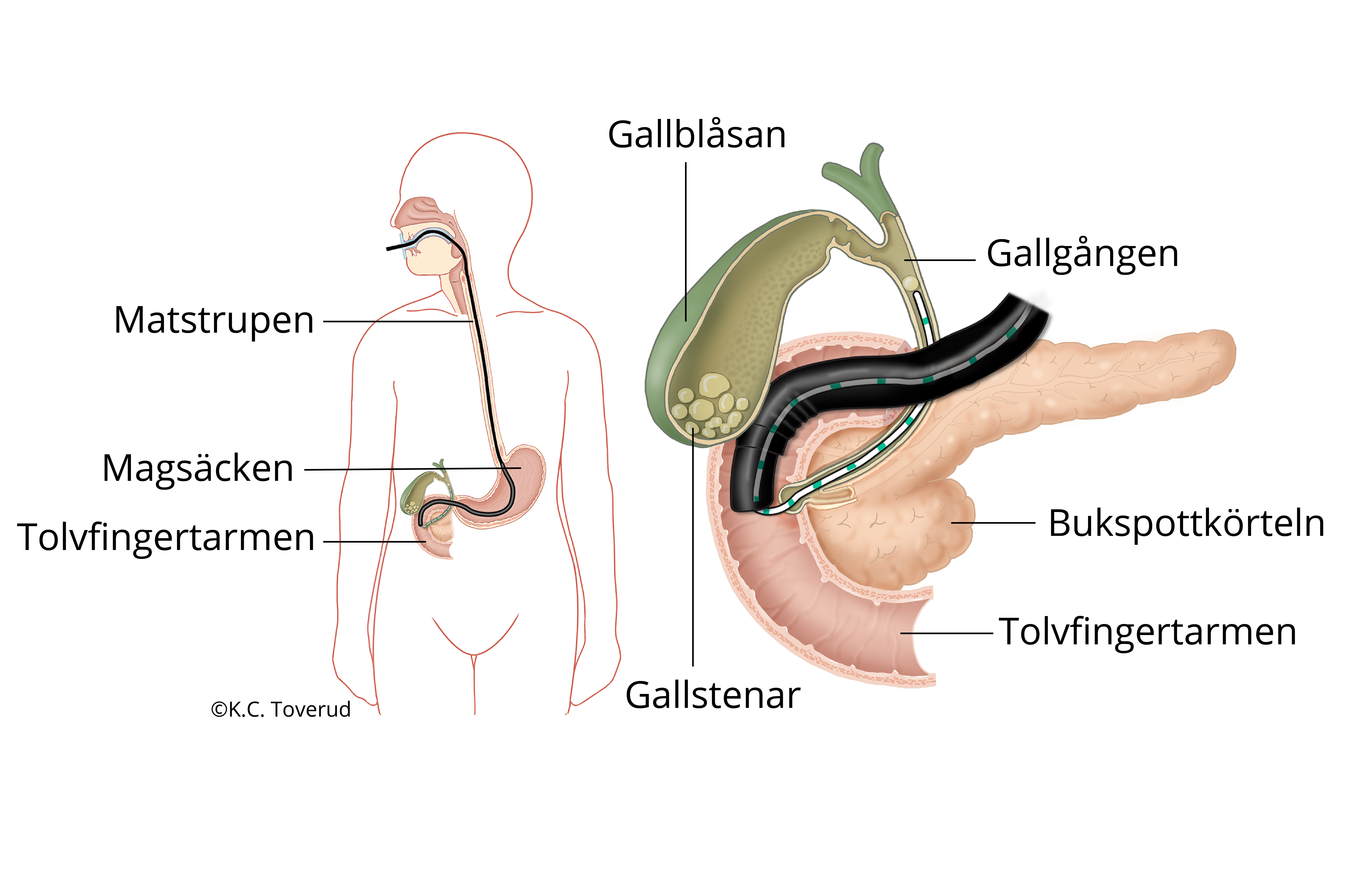 Anatomisk bild av ett duodenoskop i matstrupen och magsäcken. 