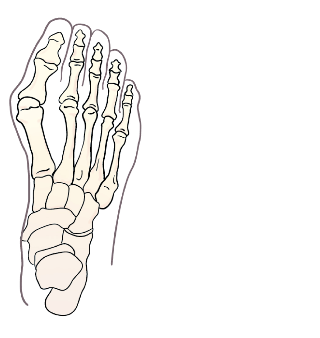 När du har hallux rigidus kan det göra ont i stortån. Speciella skor och inlägg hjälper ofta. 