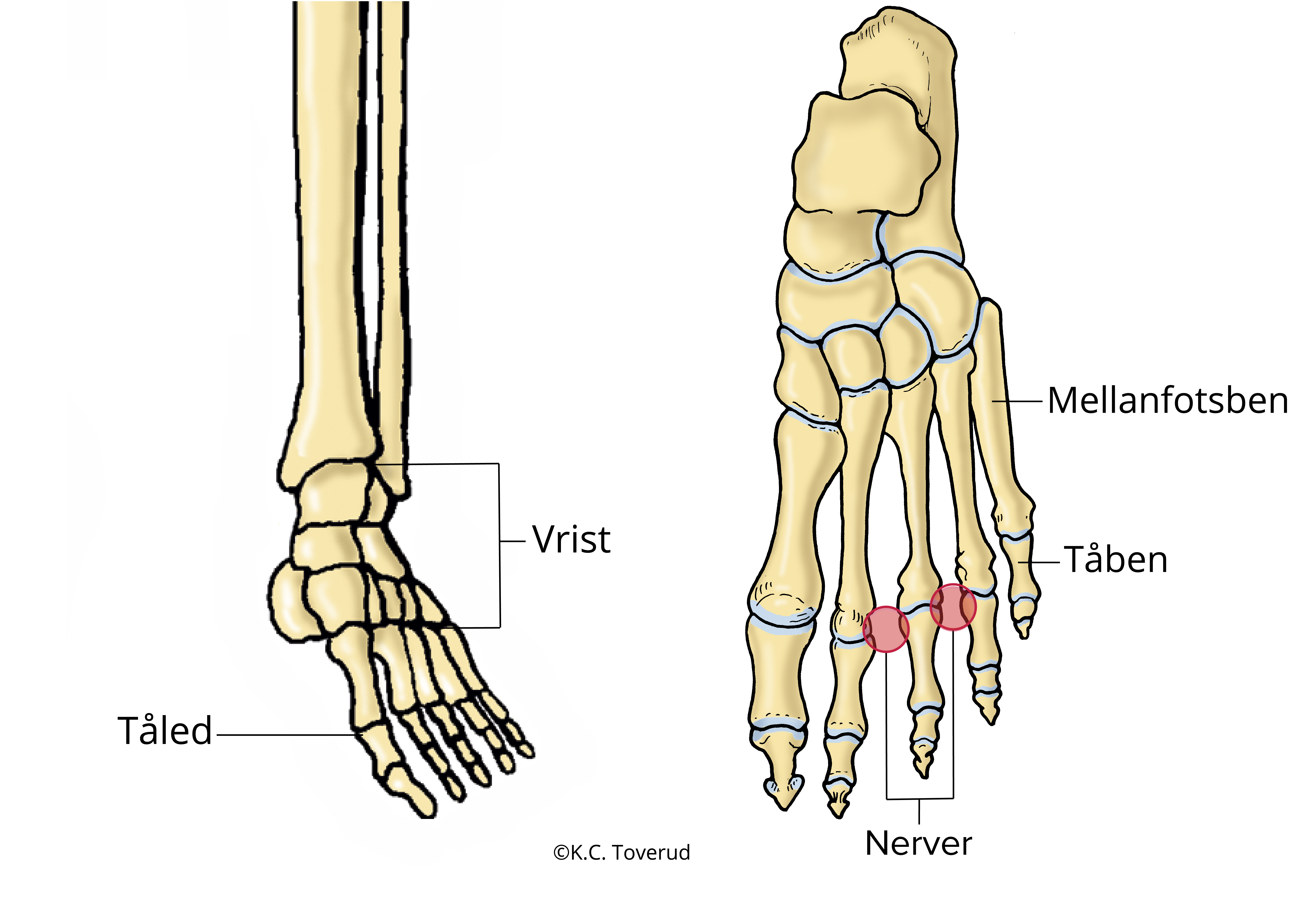 Fotens skelettdelar och nerver som kommer i kläm