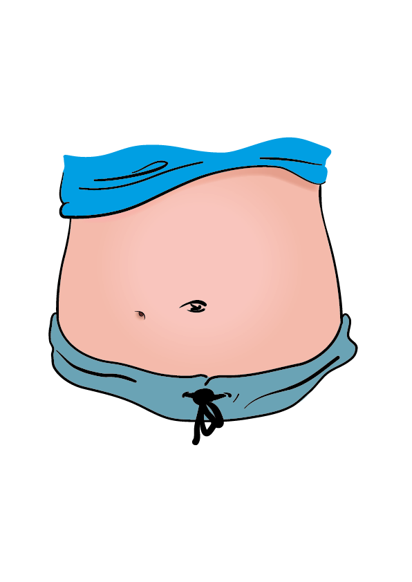 Bilden visar öppningen på magen där blindtarmsstomin sitter.