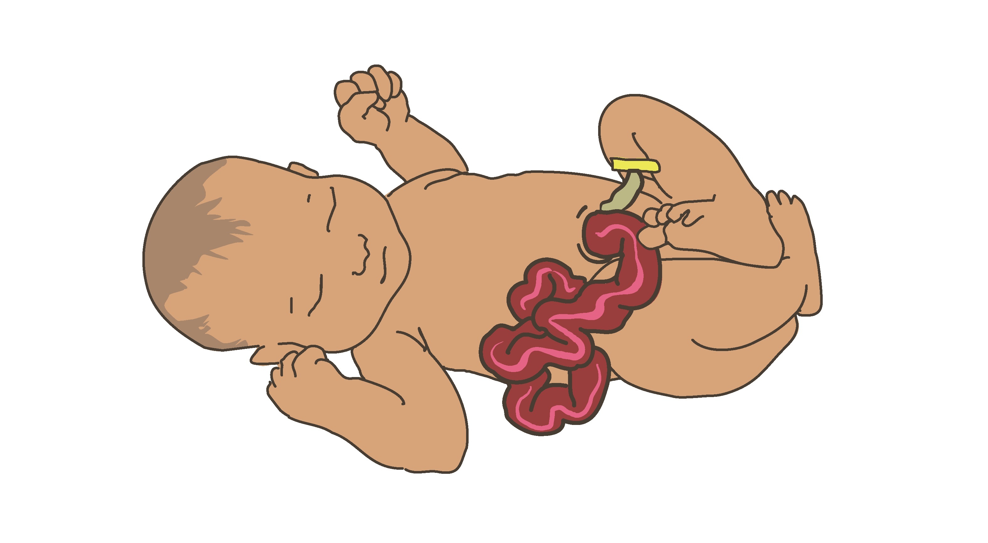 Nyfött barn med gastroschisis där tarmarna ligger utanför magen.