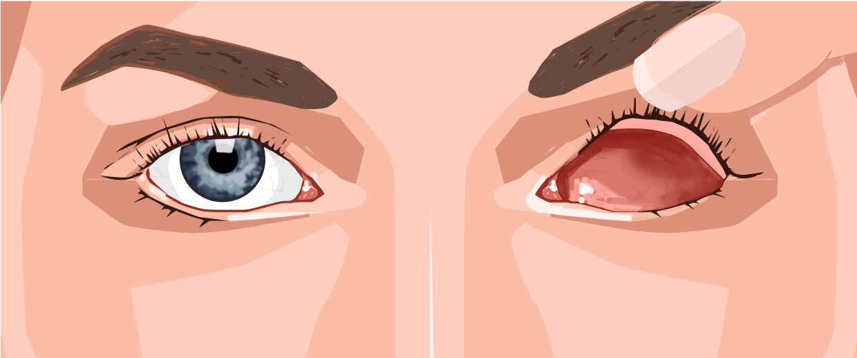 Insättning - steg 1