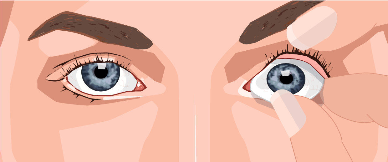 Insättning - steg 2