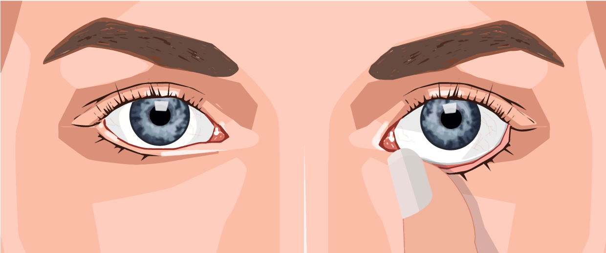 Insättning - steg 3