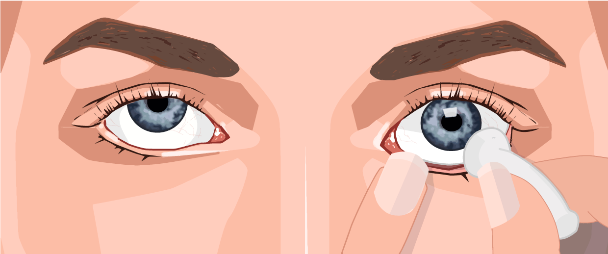 Uttagning med sugpropp