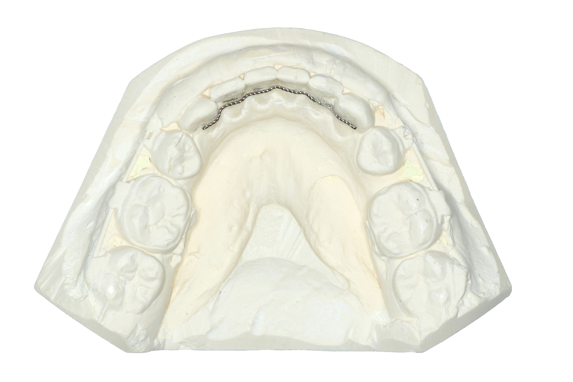 Gipsavgjutning av tänder som visar hur en metalltråd sitter fastlimmad på baksidan av tänderna.