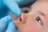 Pinnen är inne i näsan på barnet