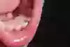 Bild på dubbla tänder, när de nya tänderna växer fram innan mjölktänderna har lossnat. 