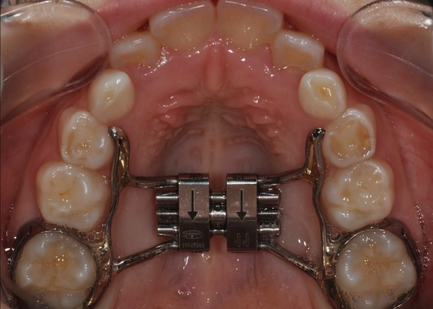 Suturvidgare - tandstödd