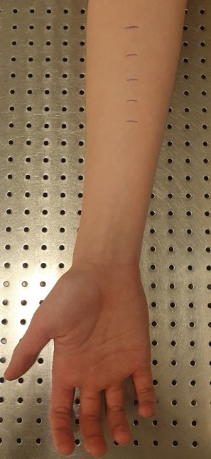 Streck på underarmen