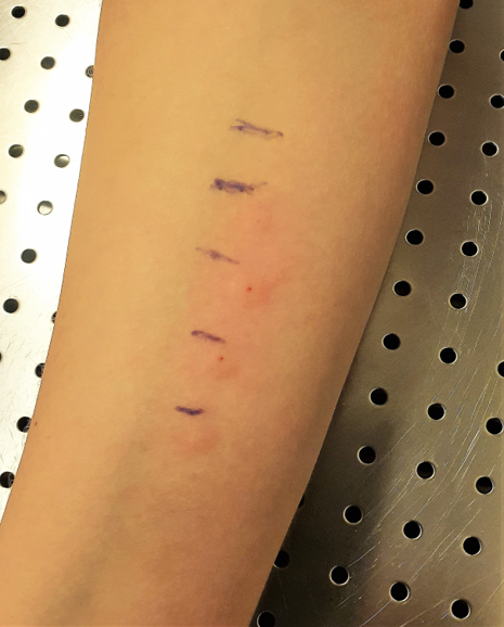 Svullnad och rodnad på huden