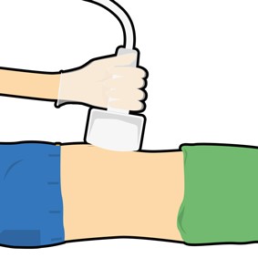 Apparat mot en bar mage